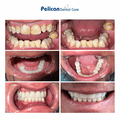 Before and after of a full arch restoration with crowns and implants at Pelican Dental Care in Vero Beach. Photo